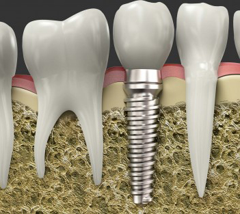 dental implants